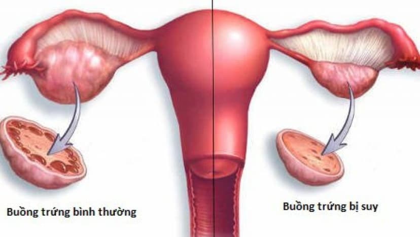 Suy buồng trứng sớm là gì? Nguyên nhân, triệu chứng, cách phòng ngừa và điều trị hiệu quả