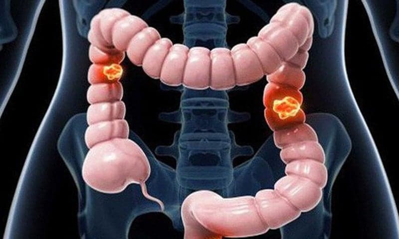 Polyp Đại Tràng: Nguyên Nhân, Triệu Chứng Và Các Phương Pháp Điều Trị Hiệu Quả