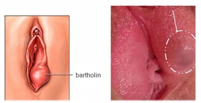 U nang tuyến Bartholin: Nguyên nhân, triệu chứng và cách điều trị