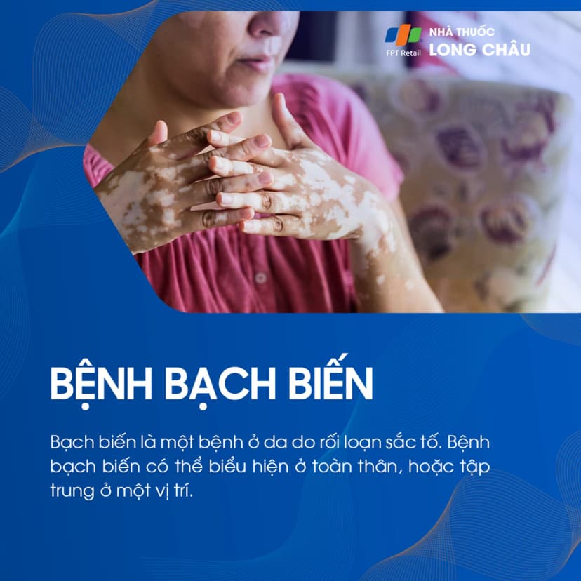 Bệnh bạch biến là gì? Nguyên nhân gây bệnh và nguyên tắc phòng ngừa
