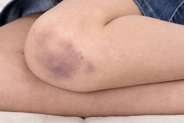 Xuất huyết giảm tiểu cầu là gì? Những điều cần biết về xuất huyết giảm tiểu cầu