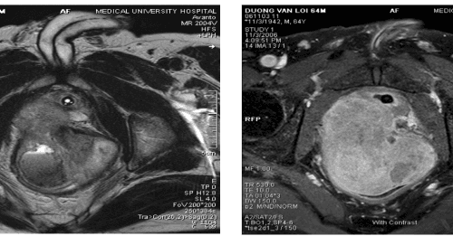 Bệnh Sarcoma Cơ Vân (Rhabdomyosarcoma): Những điều bạn cần biết về loại bệnh này