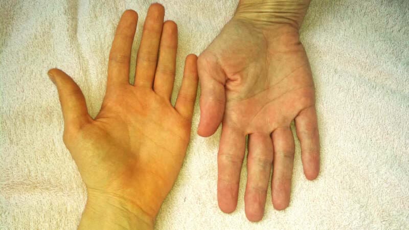 Tắc mật là gì? Những điều cần biết về tắc mật