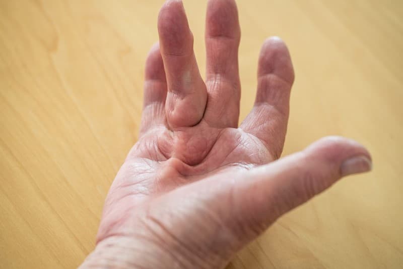 Co rút Dupuytren là gì? Những điều cần biết về co rút dupuytren