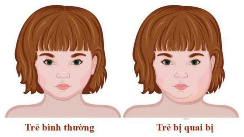 Bệnh quai bị là gì? Những điều cần biết