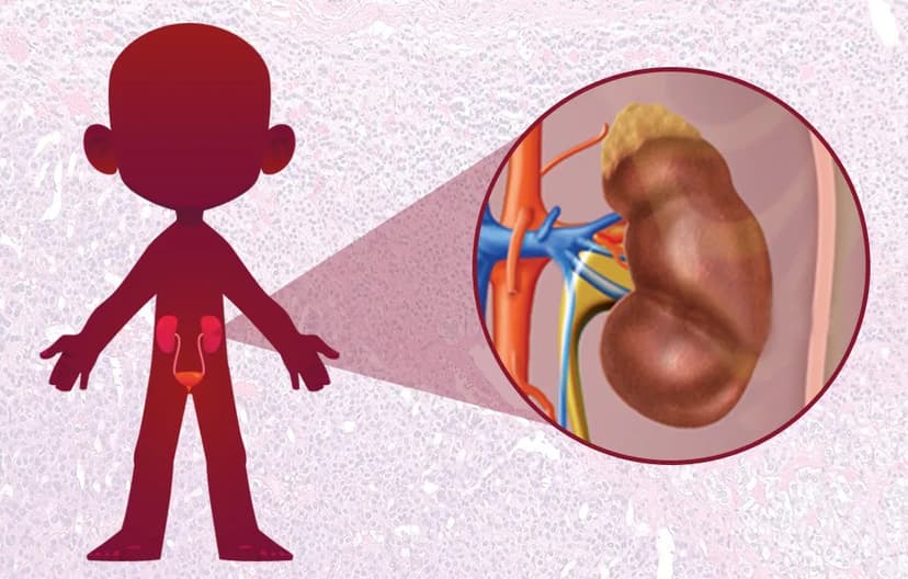 Hội chứng thận hư bẩm sinh là gì? Triệu chứng, nguyên nhân và cách điều trị hội chứng thận hư bẩm sinh