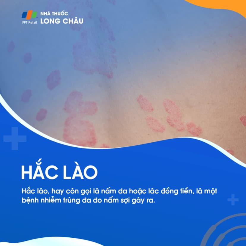 Hắc lào (Nấm da): Bệnh lý da liễu do nhiễm vi nấm gây ra