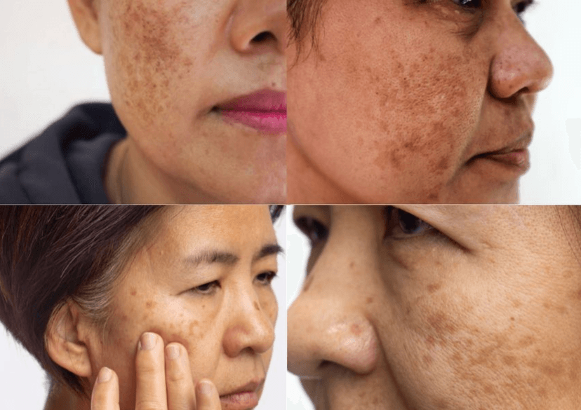 Nám nội tiết là gì? Nguyên nhân, triệu chứng và cách điều trị