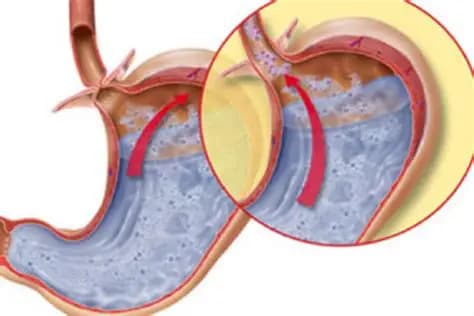Co Thắt Thực Quản: Nguyên Nhân, Triệu Chứng Và Giải Pháp Điều Trị