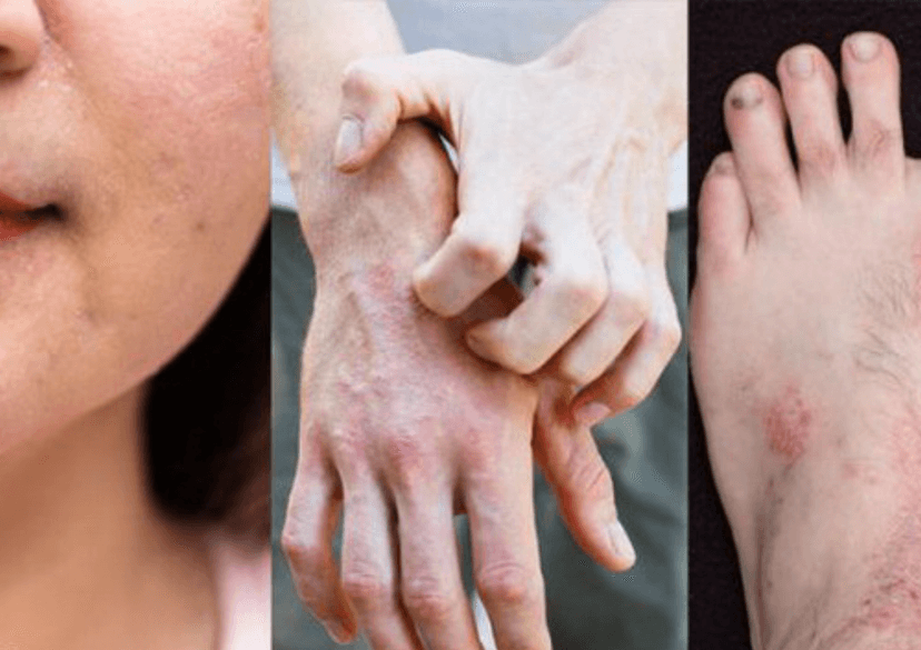 Viêm Da Do Ánh Nắng Là Gì? Triệu Chứng, Nguyên Nhân Và Cách Điều Trị Hiệu Quả