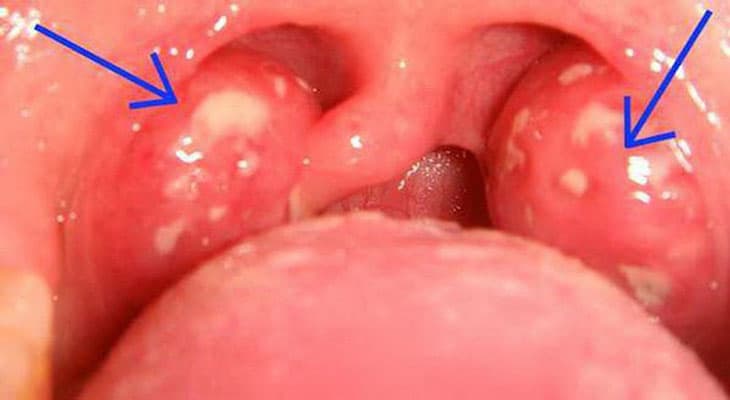 Ung Thư Amidan Là Gì? Triệu Chứng, Nguyên Nhân, Chẩn Đoán Và Điều Trị