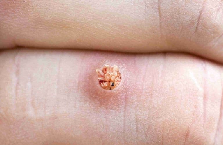 Mụn cóc, mụn cơm, hạt cơm là gì? Triệu chứng, nguyên nhân và cách điều trị