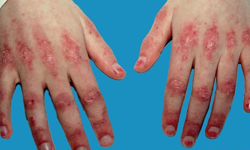 Viêm Đa Cơ Là Gì? Triệu Chứng, Nguyên Nhân Và Phương Pháp Điều Trị