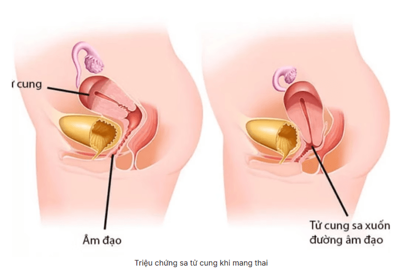 Sa tử cung khi mang thai là gì? Những điều cần biết về sa tử cung khi mang thai