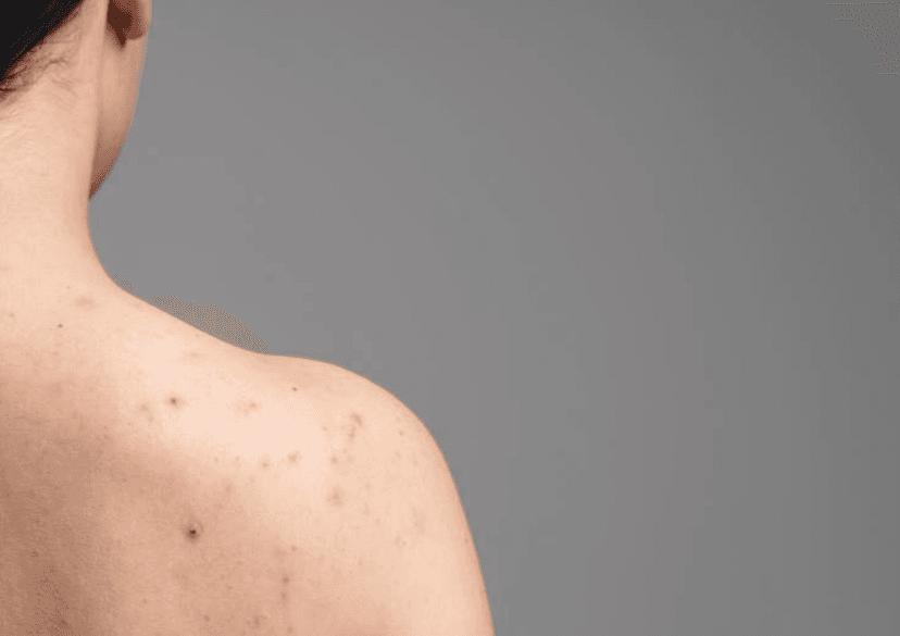 Phát Ban: Tổng Quan, Nguyên Nhân, Triệu Chứng và Cách Điều Trị