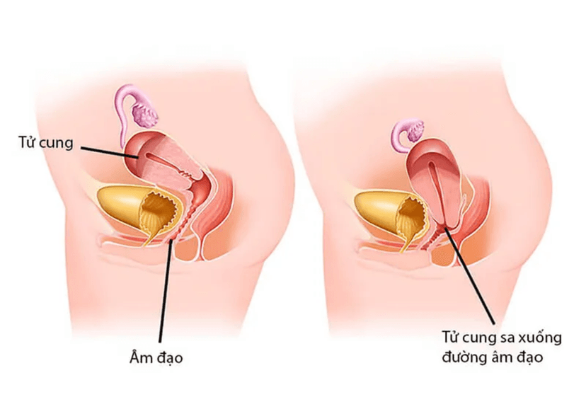 Sa tử cung sau sinh: Nguyên nhân, triệu chứng và cách điều trị