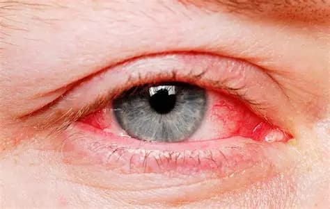 Viêm kết mạc dị ứng: Triệu chứng, nguyên nhân và cách điều trị hiệu quả