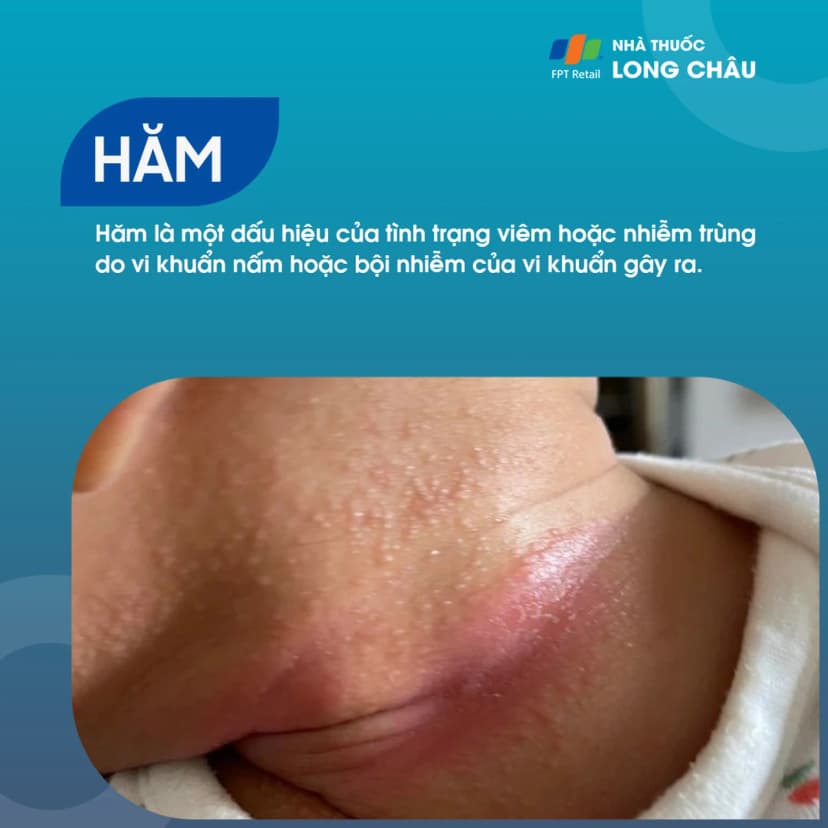 Hăm: Bệnh da liễu phổ biến vào mùa nóng và cách phòng ngừa bệnh hiệu quả
