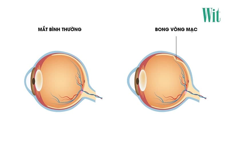 Bong võng mạc là gì? Triệu chứng, nguyên nhân và cách điều trị