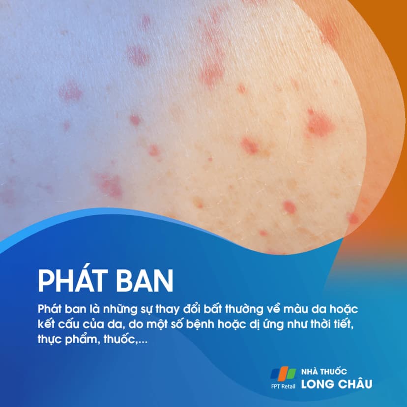 Phát ban là gì? Đặc điểm nhận biết và cách điều trị