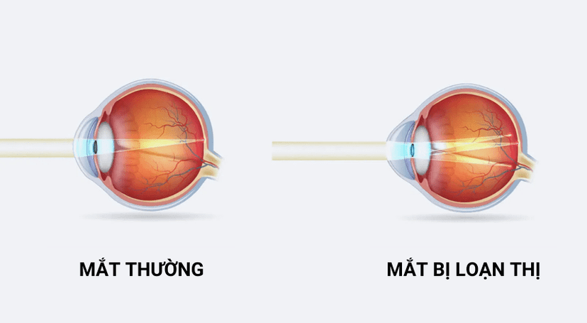 Loạn Thị Là Gì? Nguyên Nhân, Triệu Chứng, Phương Pháp Phòng Ngừa & Điều Trị Hiệu Quả
