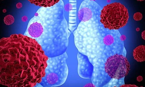 Viêm Phổi Do Nấm Là Gì? Và Những Điều Cần Biết Về Viêm Phổi Do Nấm