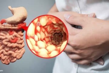 Bệnh lao ruột là gì? Triệu chứng, nguyên nhân và cách phòng ngừa bệnh.