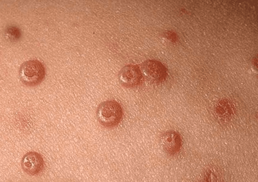 U mềm lây: Triệu chứng, nguyên nhân và cách điều trị