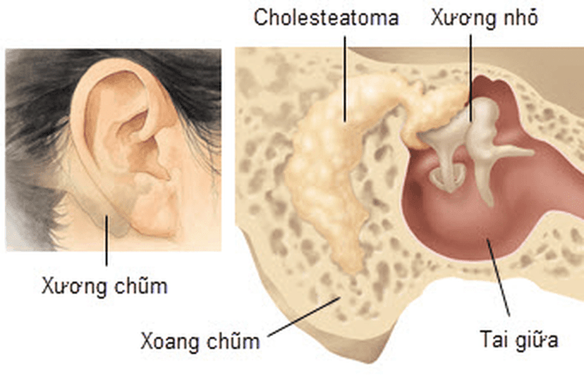 Viêm tai xương chũm: Nguyên nhân, triệu chứng, cách điều trị và phòng ngừa
