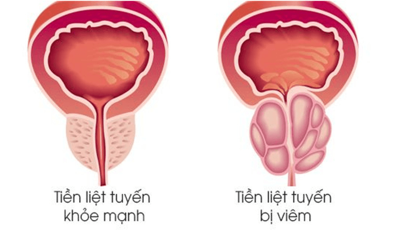 Viêm tuyến tiền liệt mạn tính là gì? Những điều cần biết