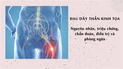 Đau Thần Kinh Tọa Là Gì? Triệu Chứng, Nguyên Nhân Và Cách Điều Trị Hiệu Quả