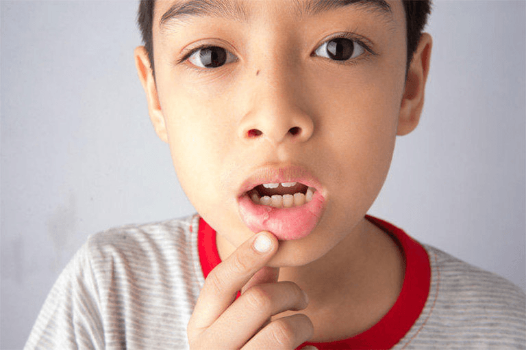 Nhiệt Miệng Là Gì? Dấu Hiệu Nhận Biết, Nguyên Nhân Và Cách Điều Trị Hiệu Quả