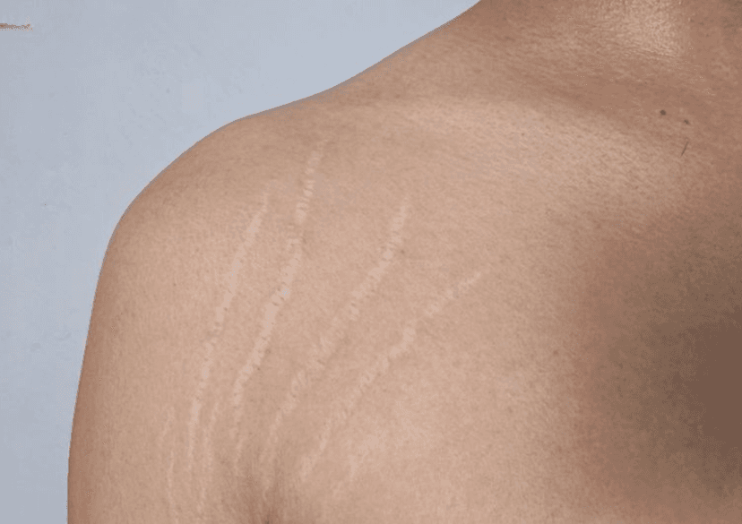 Rạn da là gì? Nguyên nhân, triệu chứng và cách điều trị hiệu quả
