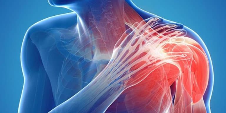 Viêm quanh khớp vai: Nguyên nhân, triệu chứng, cách điều trị và phòng bệnh