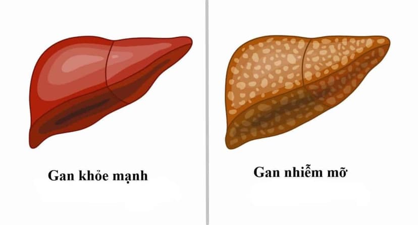 Gan Nhiễm Mỡ Là Gì? Những Điều Cần Biết Về Gan Nhiễm Mỡ