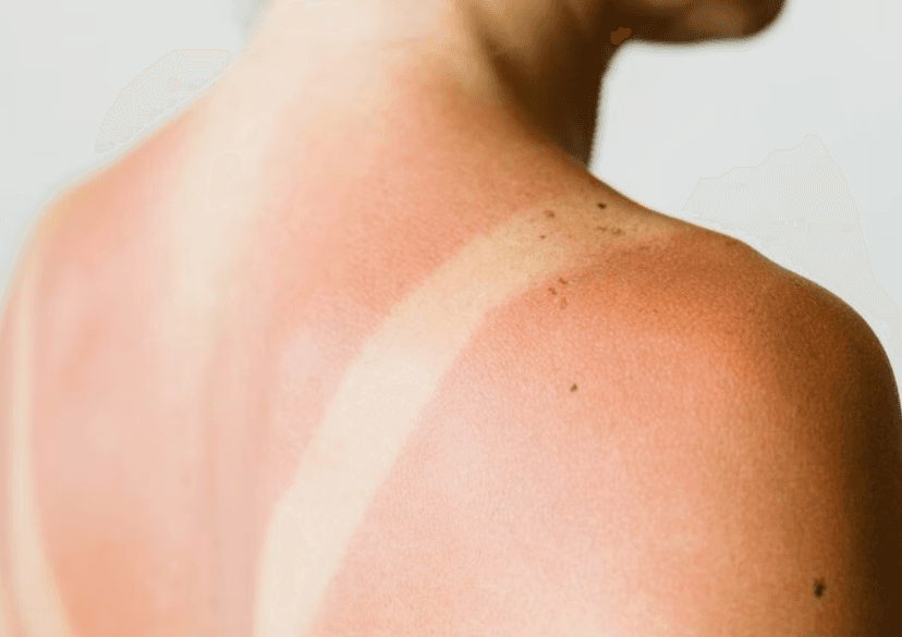 Viêm da do ánh nắng là gì? Nguyên nhân, triệu chứng và cách điều trị