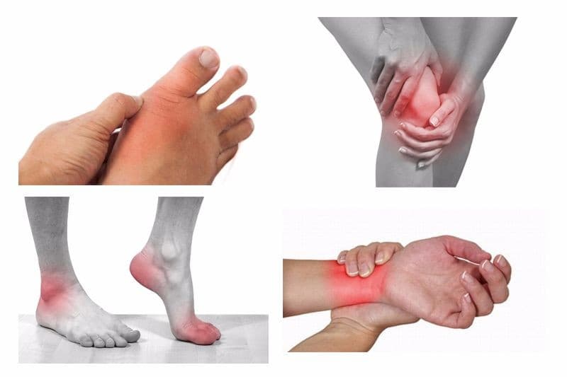 Viêm khớp: Nguyên nhân, triệu chứng, cách điều trị và phòng ngừa