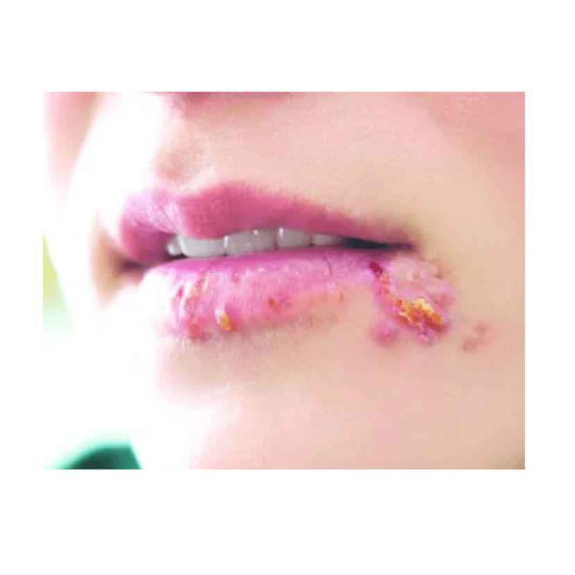 Herpes môi là bệnh gì? Nguyên nhân gây bệnh, cách điều trị và phòng ngừa