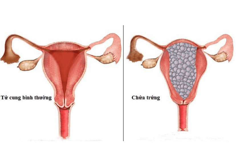Chửa trứng là gì? Những điều cần biết về chửa trứng