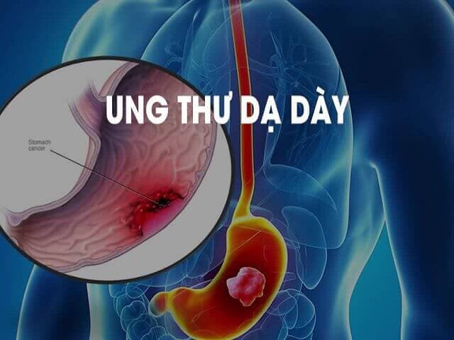 Ung Thư Dạ Dày Là Gì? Triệu Chứng, Nguyên Nhân, Phòng Ngừa và Điều Trị