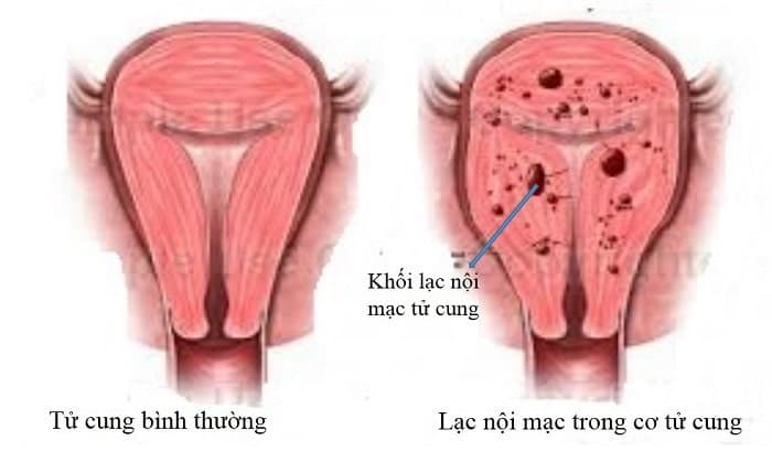 U lạc nội mạc tử cung – Nguyên nhân, triệu chứng, chẩn đoán và điều trị