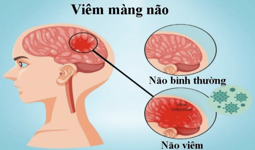 Bệnh viêm màng não là gì? Những điều cần biết về bệnh