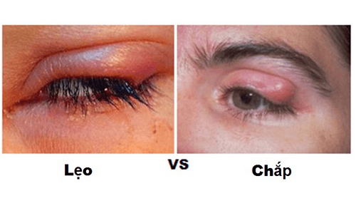Chắp và lẹo mắt: Nguyên nhân, triệu chứng và cách điều trị