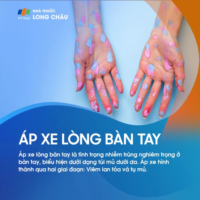 Áp xe lòng bàn tay: Nguyên nhân, triệu chứng và phương pháp điều trị