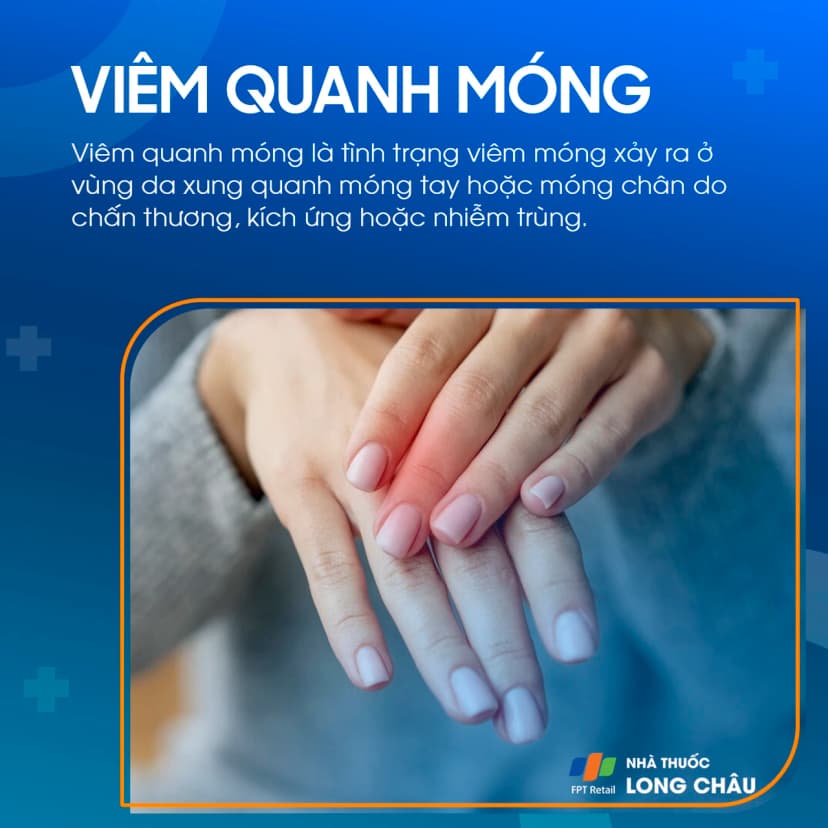 Viêm quanh móng là gì? Nguyên nhân gây bệnh và nguyên tắc phòng ngừa viêm quanh móng