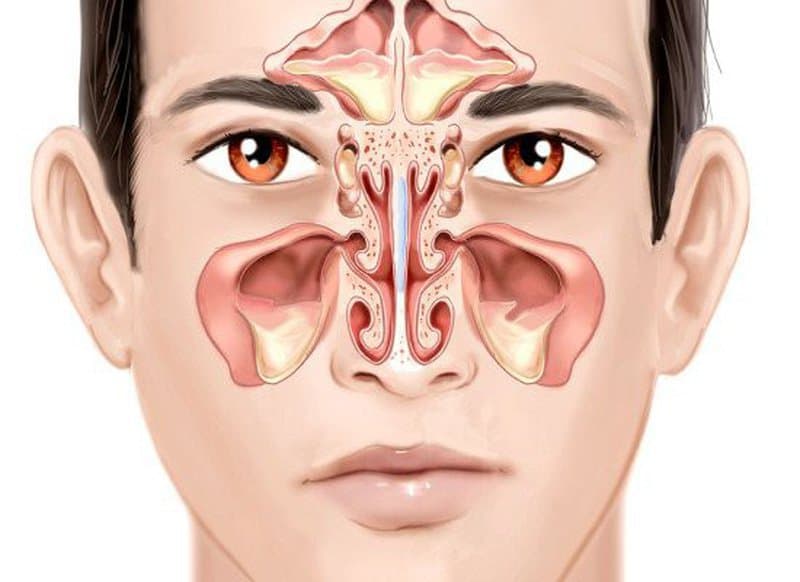 Viêm xoang hàm: Nguyên nhân, triệu chứng, chẩn đoán và điều trị