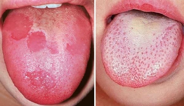 Ung Thư Lưỡi: Triệu Chứng, nguyên nhân và phương pháp điều trị về bệnh
