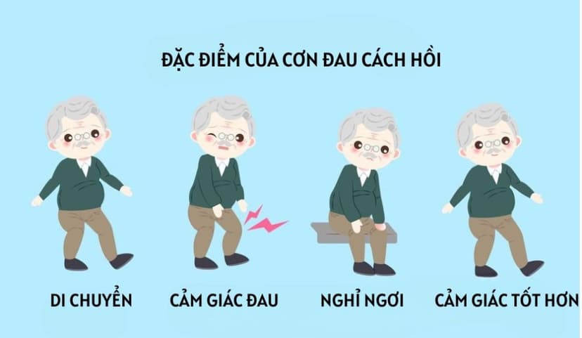 Đau cách hồi là gì? Những điều cần biết về đau cách hồi