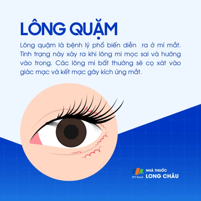Lông quặm là gì? Nguyên nhân và cách phòng ngừa