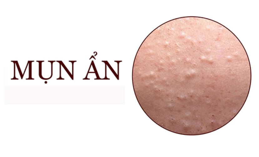 Mụn ẩn là gì? Nguyên nhân, triệu chứng và cách điều trị hiệu quả